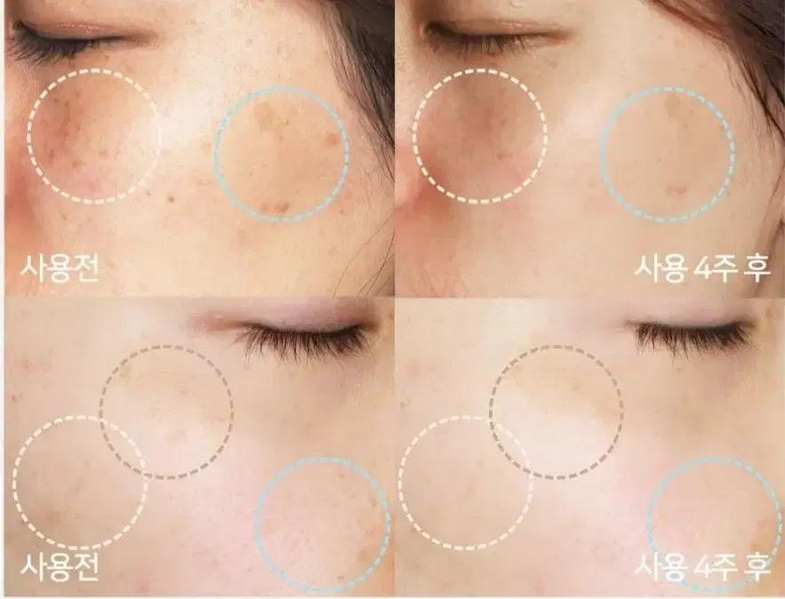 피부과No 효과100% 토닝 레이저 필요X ,기미 주근깨 잡티 미백 크림